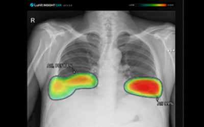 루닛 “흉부 엑스레이 솔루션, 전문의 수준 정확도 입증”