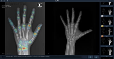 뷰노, AI 골연령 판독 보조 솔루션 대만 인증 획득