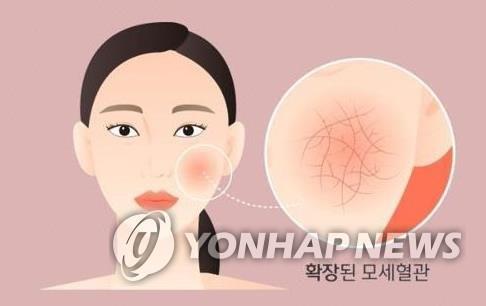 "갱년기 안면홍조, 특이 식단으로 해소 가능"