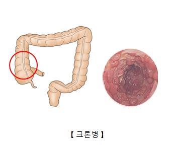 "염증성 장 질환 환자, 절반이 아연 결핍"