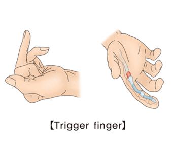 "'방아쇠 손가락', 당뇨병 징후"