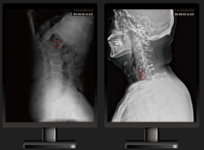 딥노이드, 척추 의료영상 AI 솔루션 식약처 인증 획득 