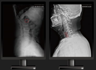 딥노이드, 척추 의료영상 AI 솔루션 식약처 인증 획득