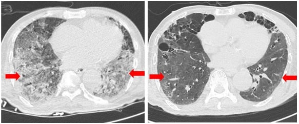 줄기세포치료제 투여 전과 후 흉부 CT./자료 제공/파미셀