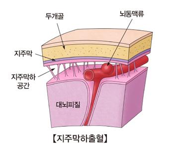 미국서 출혈성 뇌졸중 늘고 있다