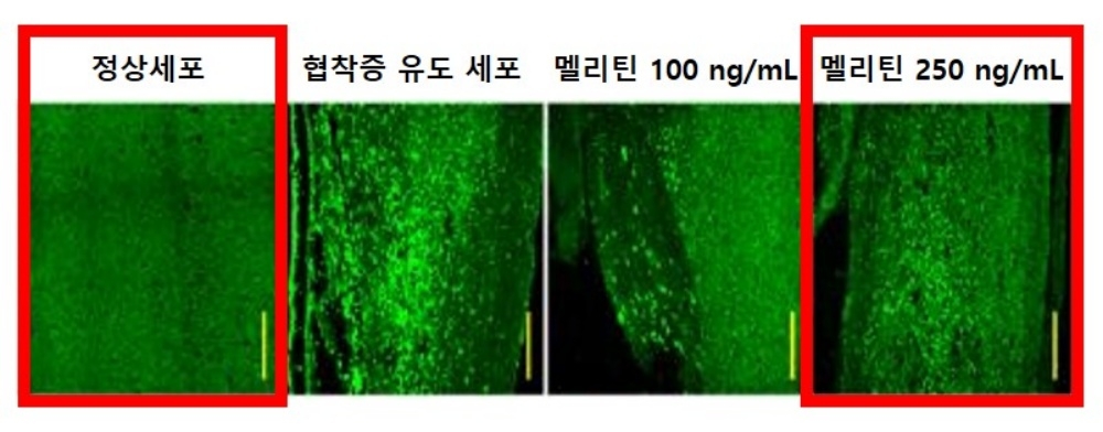 "봉독 성분 '멜리틴' 척추관협착증 치료 효과 규명"