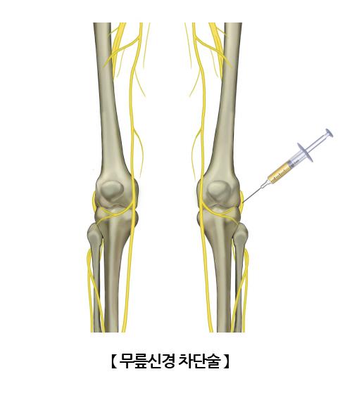 "무릎 관절염 통증, 무릎신경 차단술 '단기' 효과"