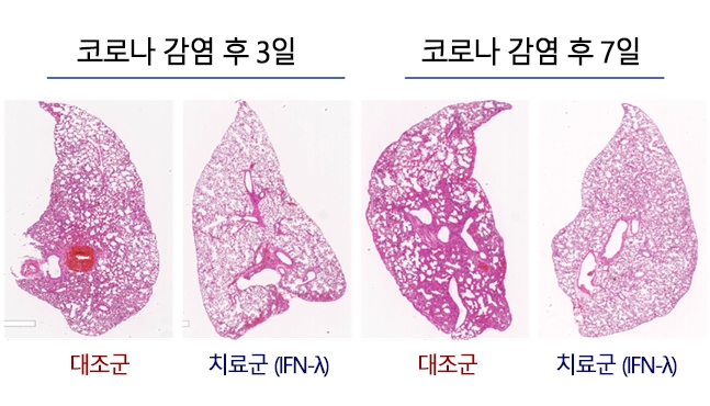 서울대병원 연구팀 "콧속 흡입형 코로나19 치료제 개발 연구중"