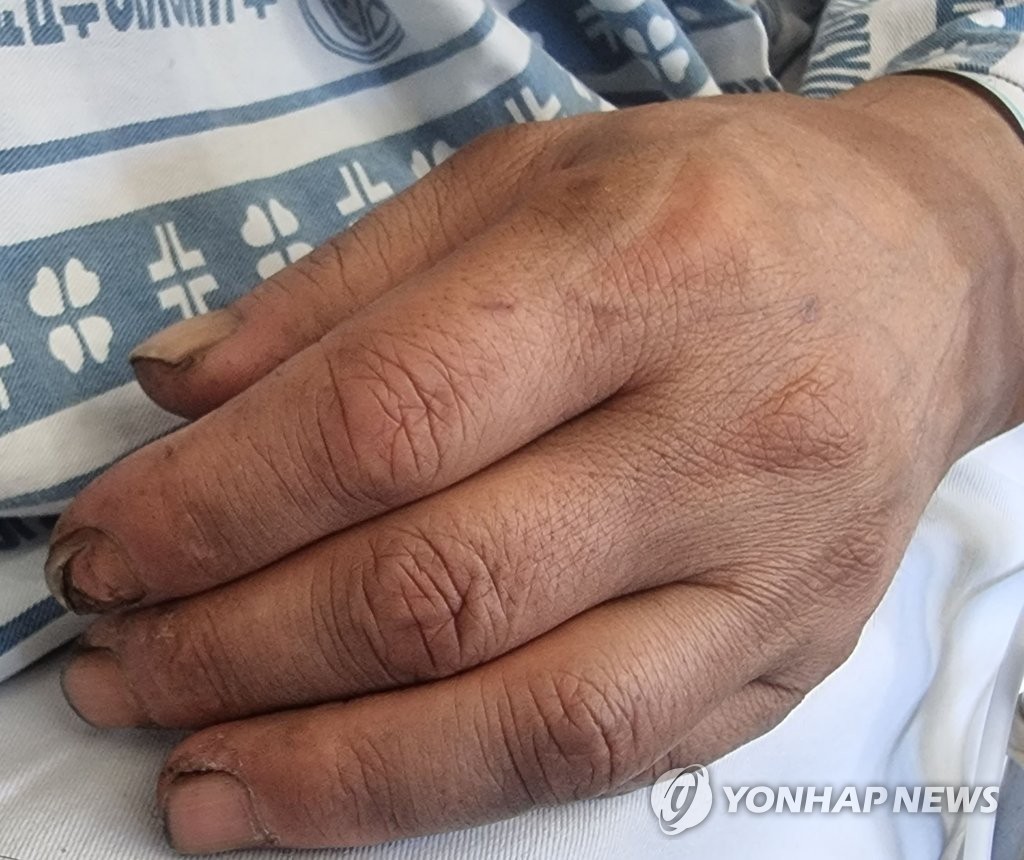 극적 생환 광부들 병원 치료 나흘째…산업재해 보상 신청