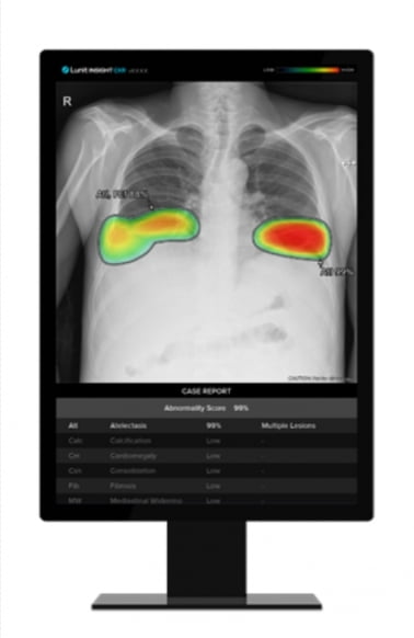 카지노 차무식 인사이트 CXR, 교도소 내 결핵 검진서 성능 입증