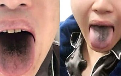 혀·치아 검게 변했다…중국서 코로나 신종 변이가?