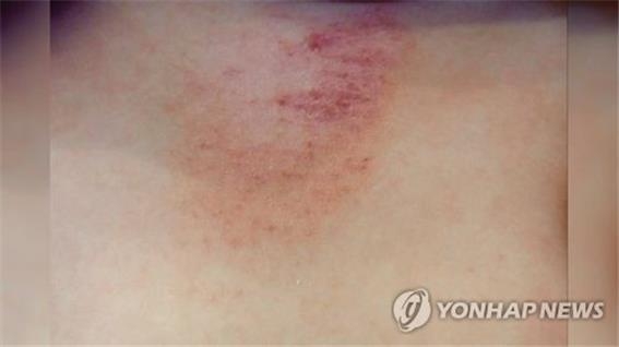 "로카티니리맙, 아토피성 피부염 완치 가능성"