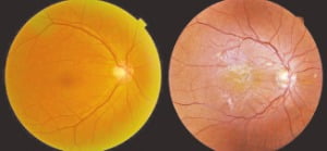 정상인(왼쪽)과 망막앞막 환자(오른쪽)의 안저 사진. 황반부에 하얀 반투명막과 이로 인한 망막전층의 주름 및 혈관 변형이 관찰된다.  김안과병원 제공 