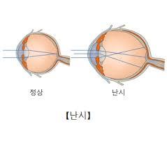 "부모 난시면 자녀도 난시 위험↑"