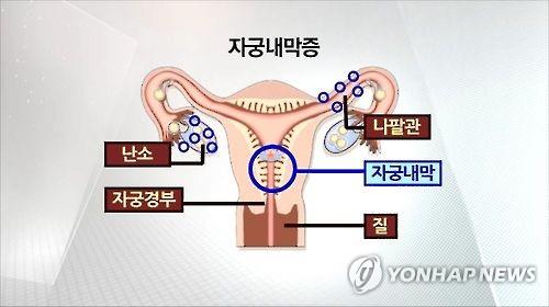 "자궁내막증, 정신질환과 유전적 연관성"