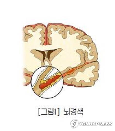 "뇌졸중 위험요인, 연령대 따라 차이"