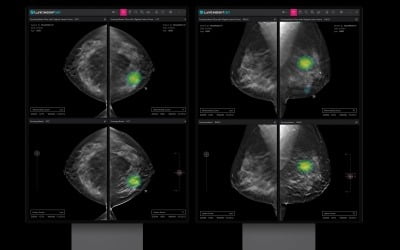 루닛, 3차원 유방암 검진 AI 솔루션 유럽 출시