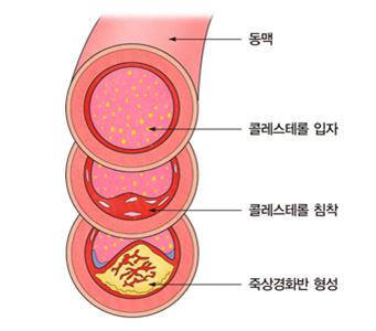 동맥경화는 자가 면역 질환?