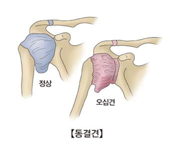 "당뇨병, 오십견 위험↑"