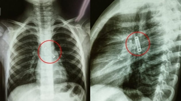 5세 남아의 폐에서 3cm 길이의 금속 스프링이 발견됐다. /사진=해당 병원 의사 페이스북 사진 갈무리