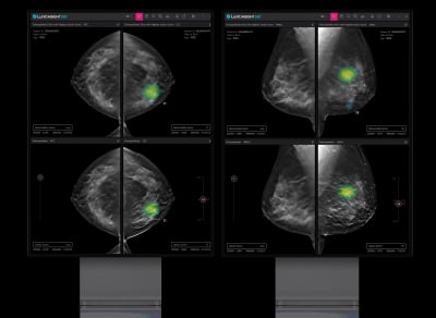 루닛 "3차원 유방암 검진 AI 솔루션, 이달 말 유럽 판매"