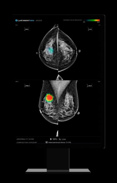FDA, 유방암 진단 촬영 시 치밀유방 정보 제공 의무화…왜?
