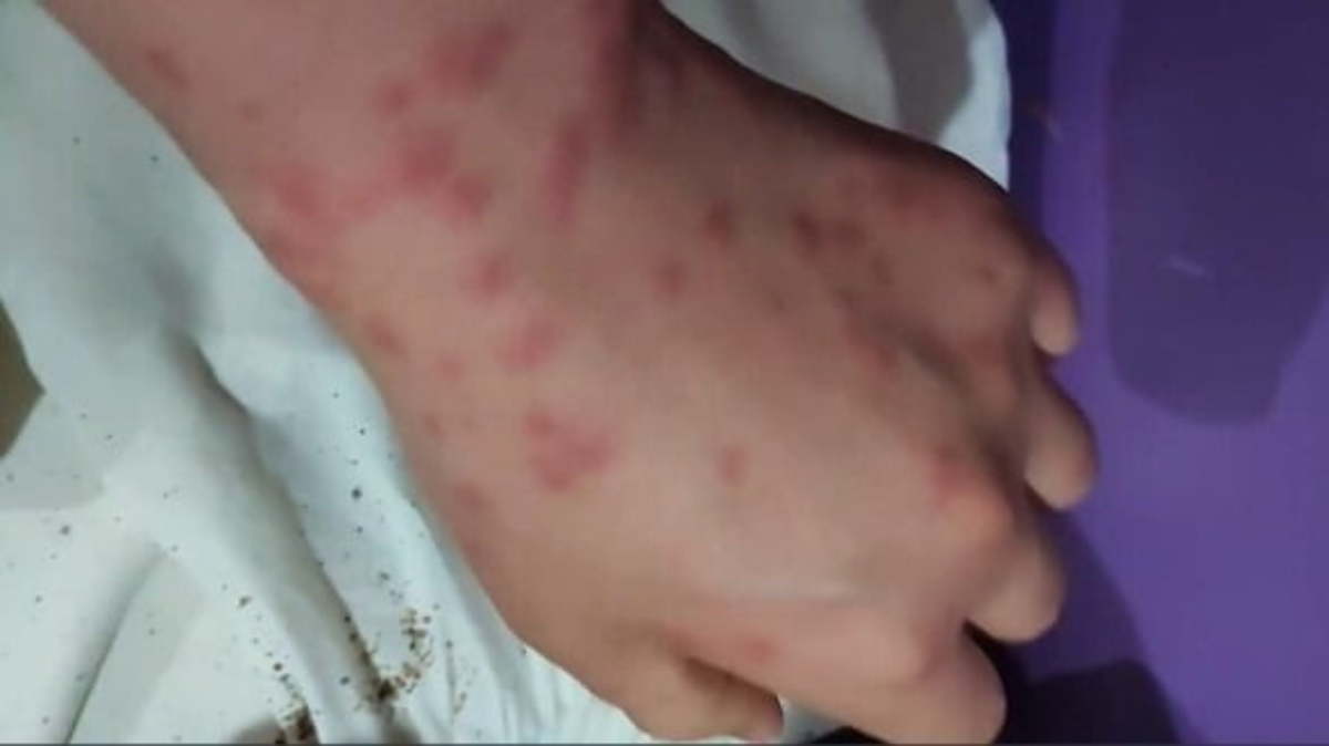 hives-all-over-the-body-after-sleeping-motel-bed-full-of-bugs