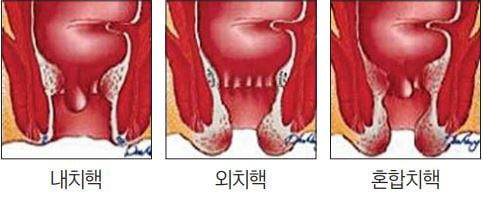 [김광호의 상쾌한 하루] 역사를 바꾼 질병, 치핵