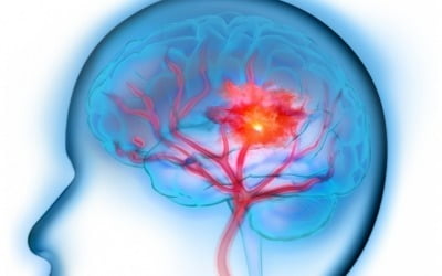 美 리치뉴로, 뇌졸중재활 전기자극장치 FDA 혁신기기 지정