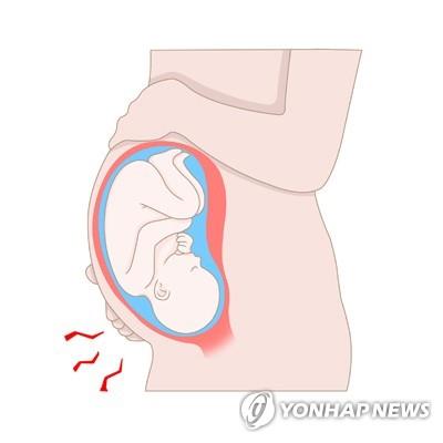 "조산아, 성인 때 천식·COPD 위험↑"