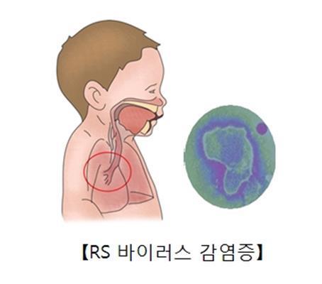 "임신 중 RSV 백신 모체 접종, 신생아 RSV 예방 효과"