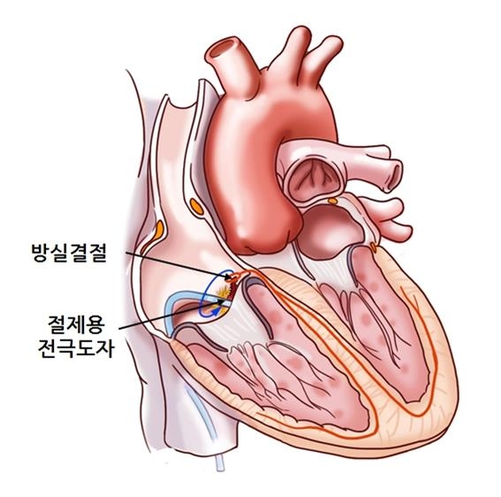 "심방세동 도자 절제술, 치매 등 뇌 기능 저하도 억제"