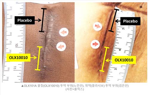 올릭스 "비대흉터 치료제, 미국 임상 2a상서 흉터 개선 확인"