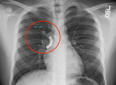 몇 달째 기침에 엑스레이 찍었더니…기관지서 발견된 '이것'