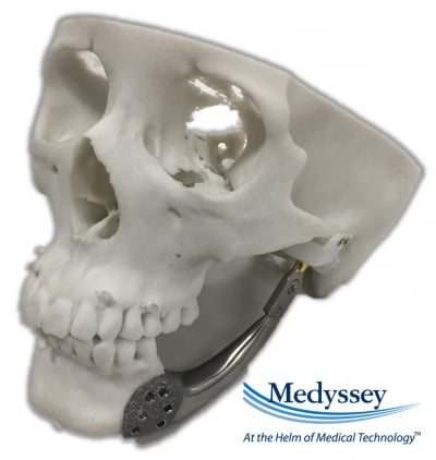 메디쎄이, 3D프린팅 환자맞춤형 인공 턱뼈 美 특허 취득