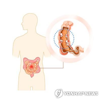 "크론병, 치료하면 정상생활 가능한 질환…편견 버려야"