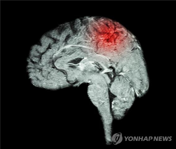 "뇌졸중 후 고혈당, 뇌 기능 저하 촉진"