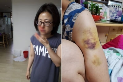 피투성이 사진 올린 황보승희 의원…"난 가정폭력 피해자"
