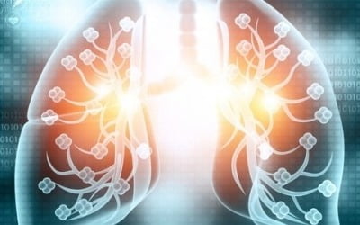 압타머사이언스, 폐암조기진단키트 상급병원 비급여 검사 시작