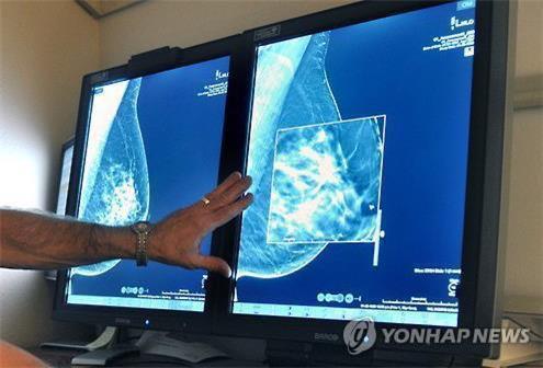 "유방암 치료제 키스칼리, 초기 유방암 재발률 25% 낮춰"