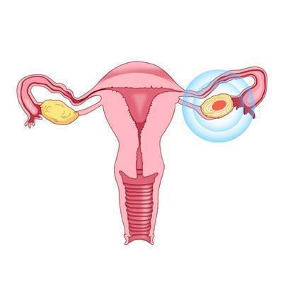 "두 항암제 병행 투여, 난소암에 획기적 효과"
