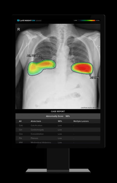 루닛, 국립경찰병원에 흉부 엑스레이 AI 분석 솔루션 공급