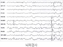 "치매 조기 진단 특수 뇌전도 개발"