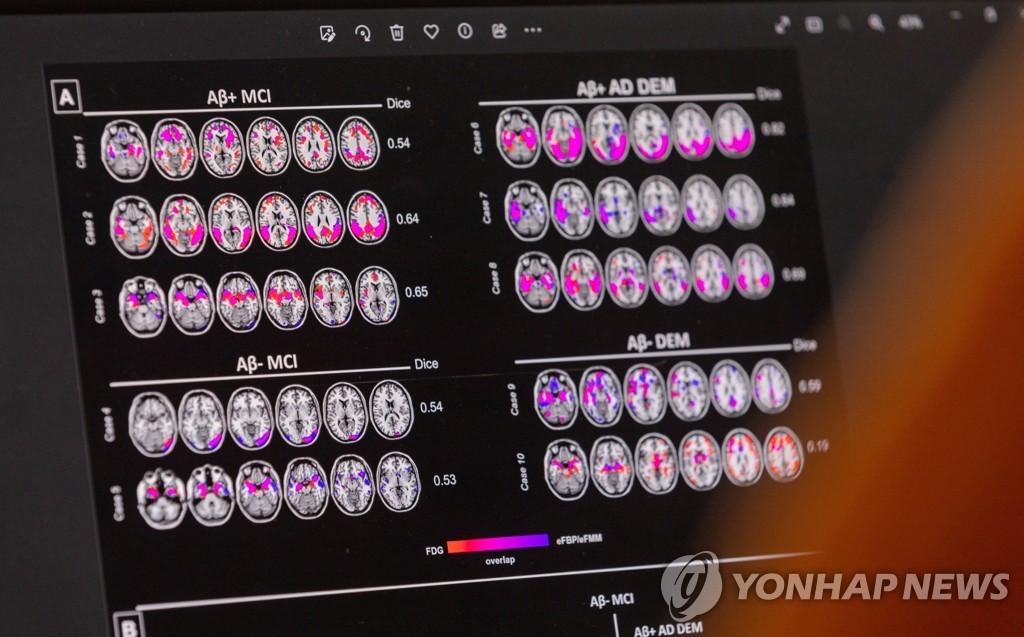 미 FDA, 알츠하이머 진행 속도 늦추는 신약 정식승인(종합)