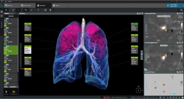 폐결절 검진 솔루션 ‘AVIEW LCS PLUS’. 사진 제공=코어라인소프트