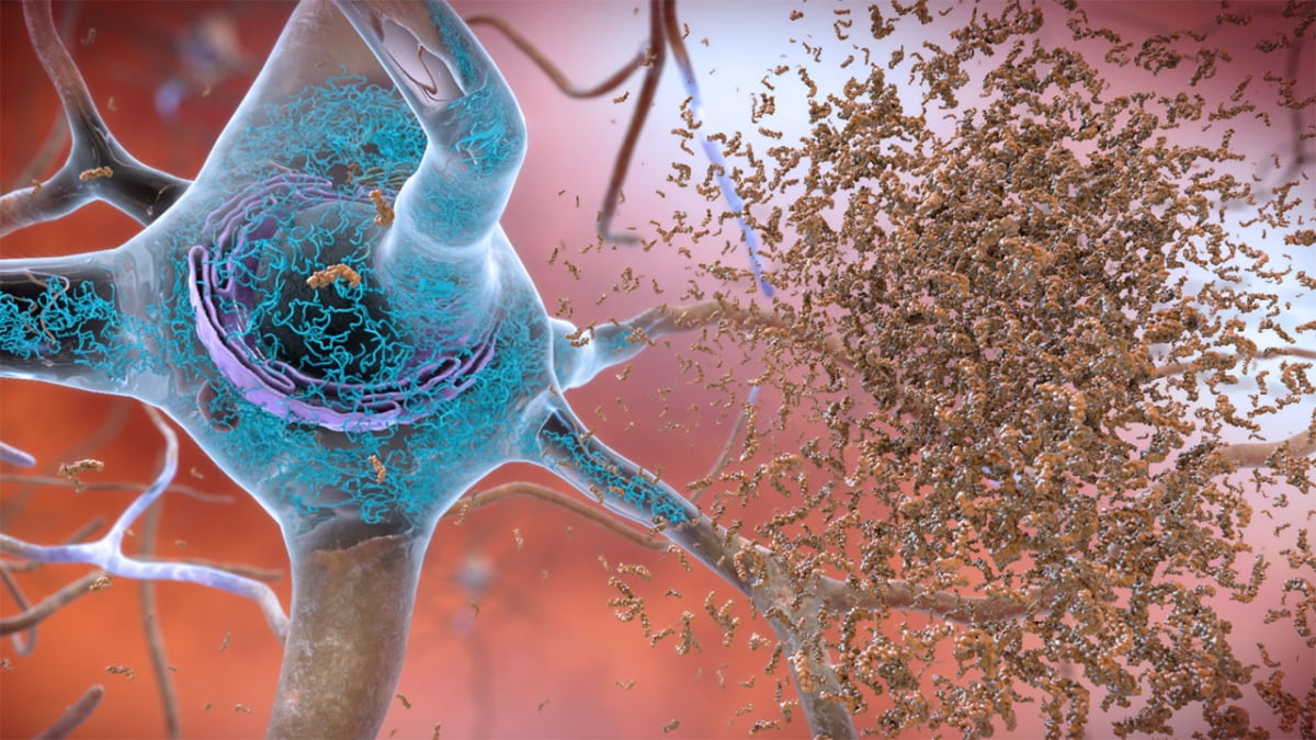 뇌 신경세포에 아밀로이드 베타 단백질이 쌓인 모습./미국 국립노화연구소
