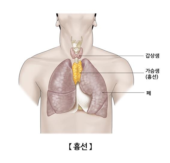 "흉선 절제, 사망 위험↑"