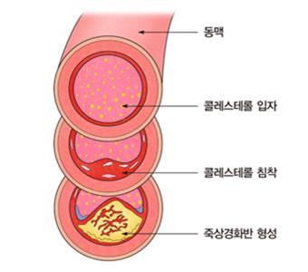 동맥경화 새 치료법 개발