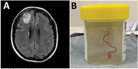 건망증 앓던 호주 여성, 뇌 속에 8㎝짜리 벌레 '꿈틀'