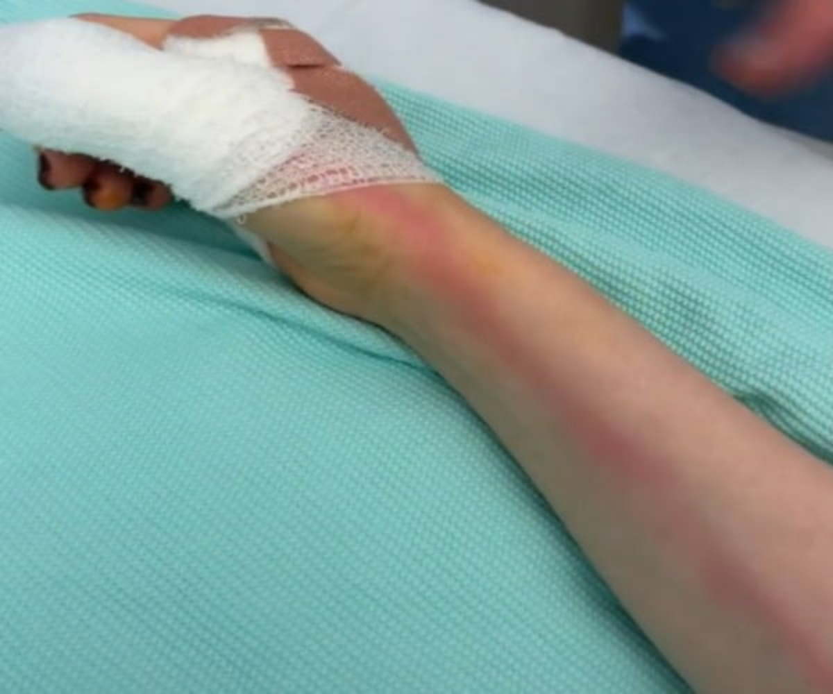 Woman Develops Sepsis After Thumb Injury: Urgent Need for Treatment